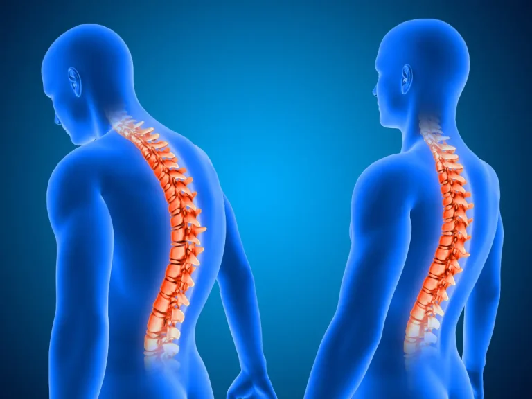 هل يمكن علاج إعوجاج العمود الفقري بدون جراحة؟